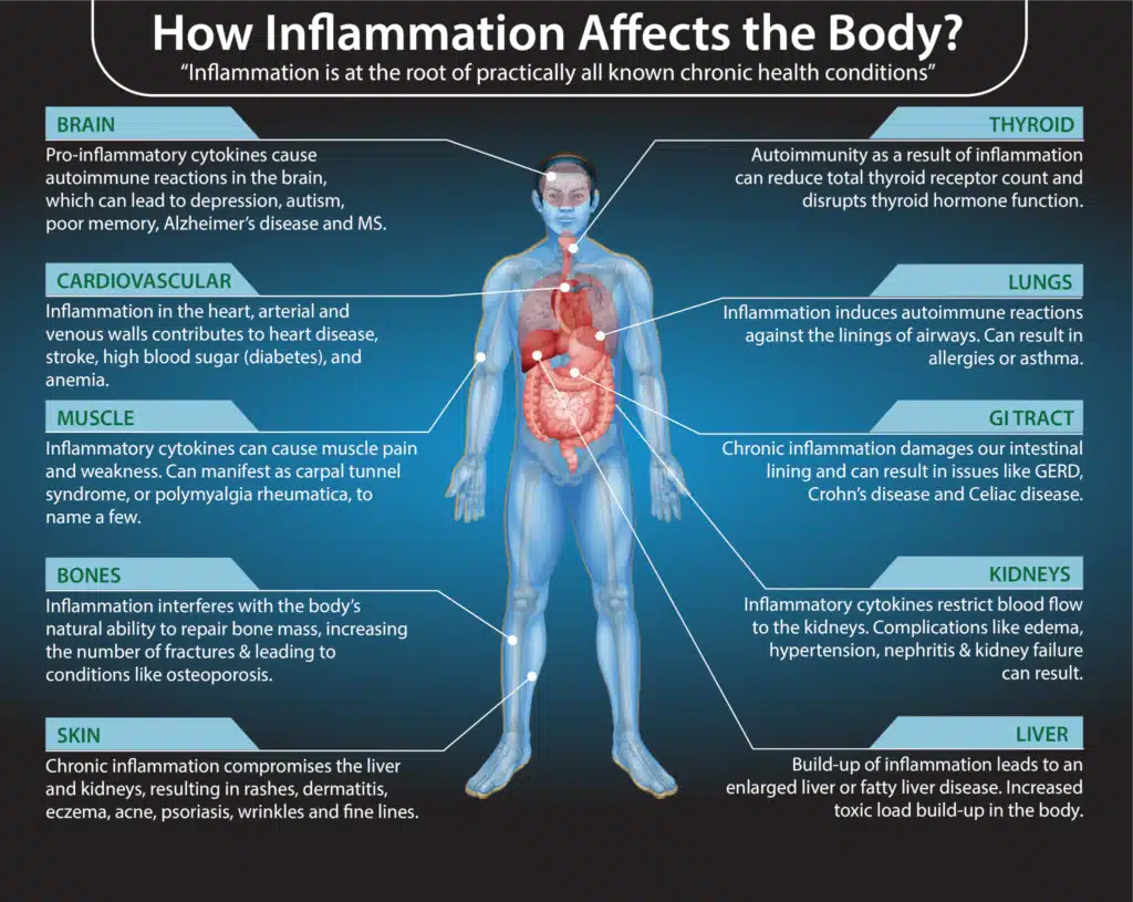 Illustration of how inflammation affects the human body including the: Thyroid, Lungs, GI tract, Kidneys, Liver, Brain, Cardiovascular, Muscles, Bones and skin.