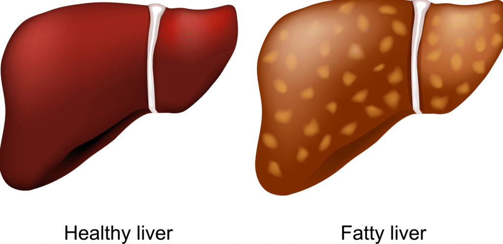 Illustration of a healthy liver and fatty liver.